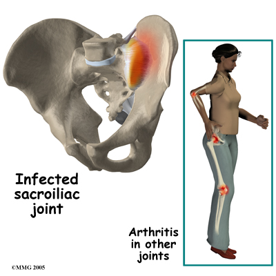 SI_joint_causes01.jpg